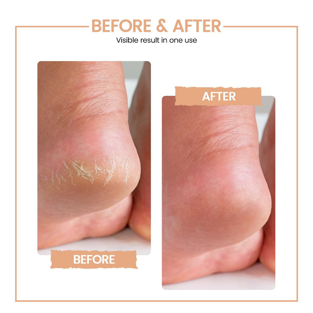 Protouch Bliss Callus Remover before and after cracked heel result