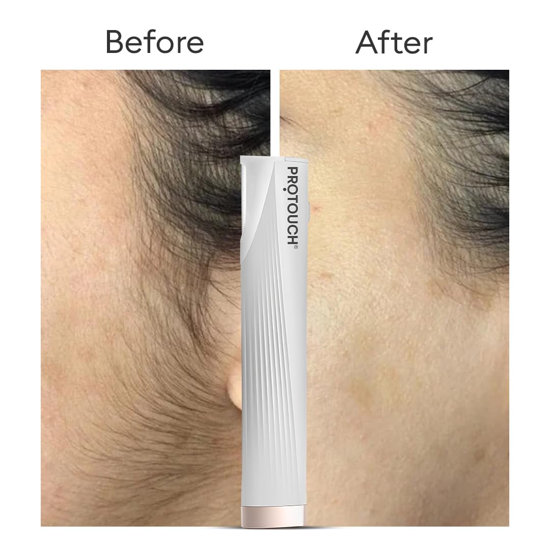 Protouch Dermaplaning Device before and after facial hair removal results on cheek