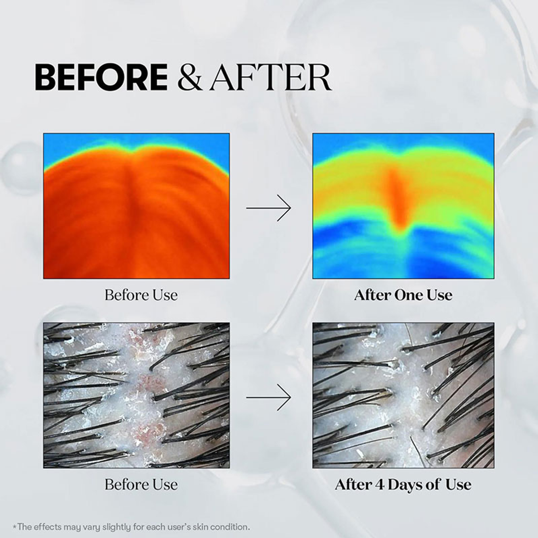 VT PDRN Reedle Shot Hair Ampoule scalp before and after results