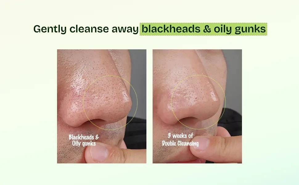 Orien Mugwort Zero Film Cleansing Foam before and after, blackheads and oily gunks on nose