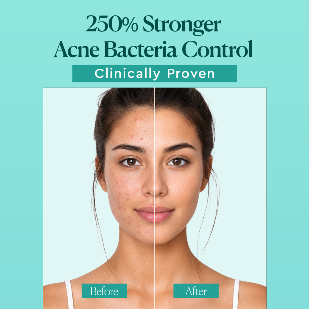 Dr. Belmeur AHA BHA Sebum Control Gel Cleanser 250% stronger acne bacteria control before and after