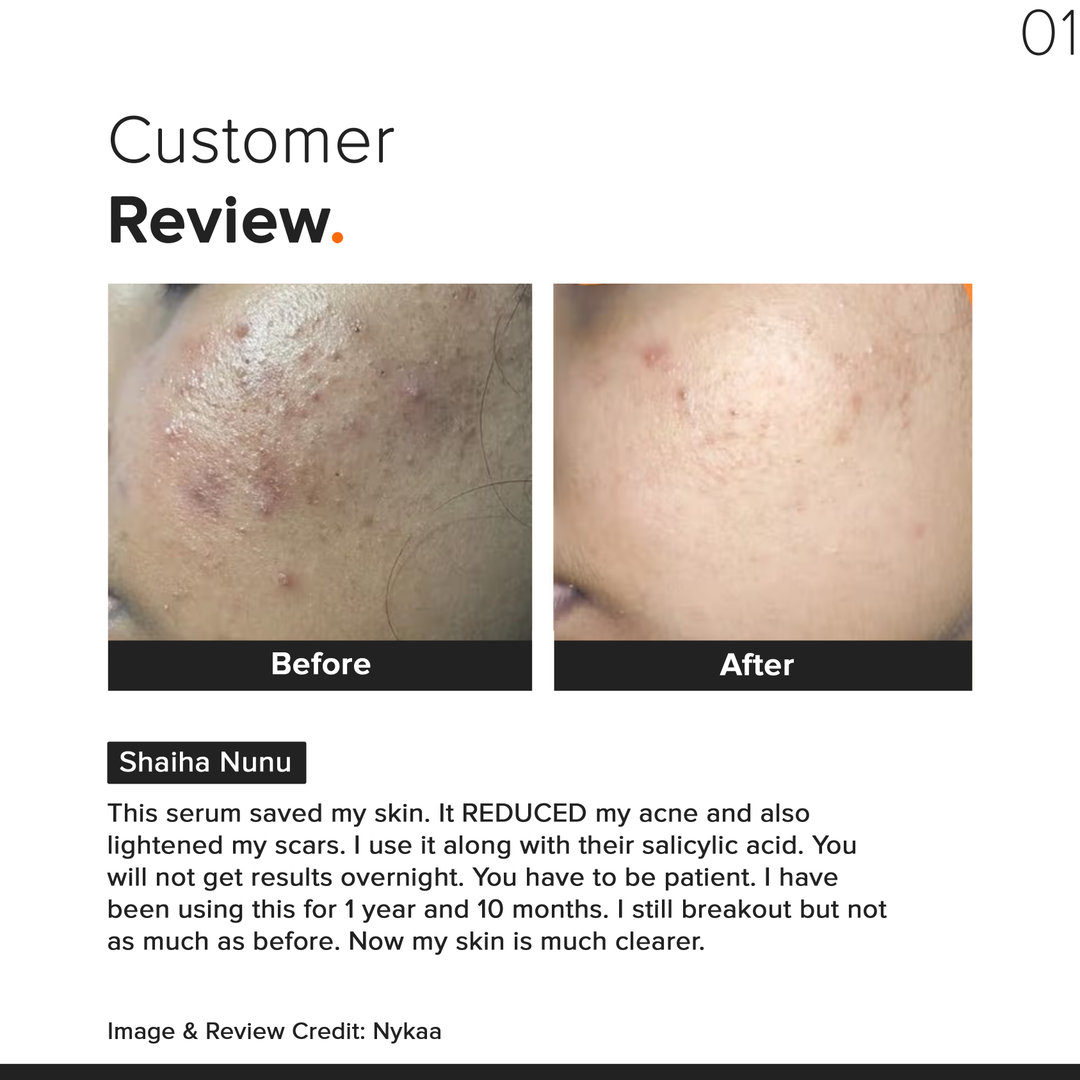 Minimalist Niacinamide 10% Face Serum before and after results, customer review on acne and scars