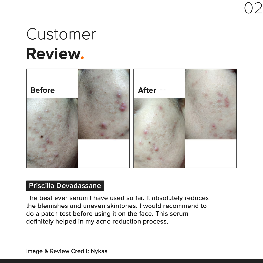 Minimalist Niacinamide 10% Face Serum 10ml before and after customer review for acne marks