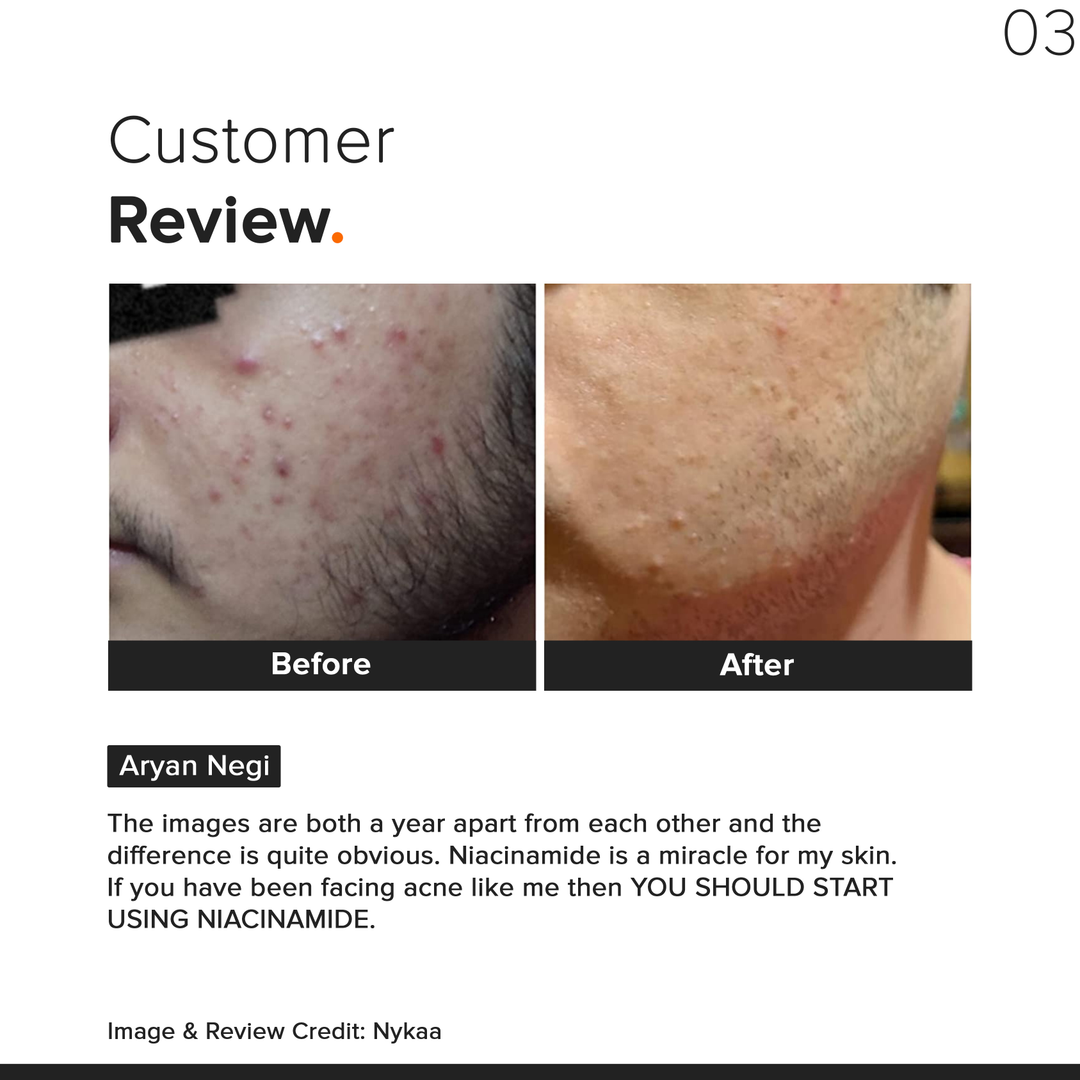 Minimalist Niacinamide 10% Face Serum before and after one year, customer review on acne