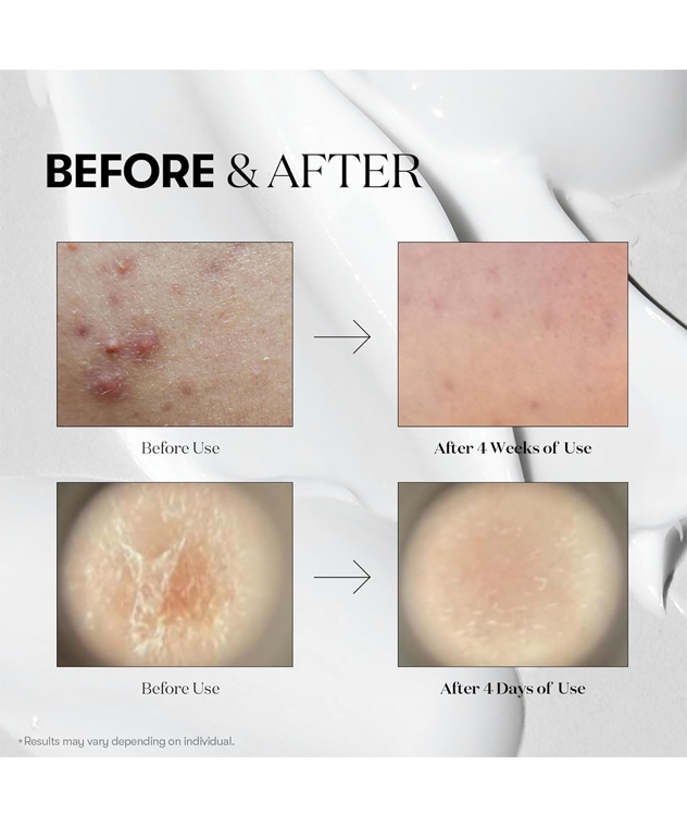 VT Reedle Shot 100 Essence before and after results after 4 weeks of use