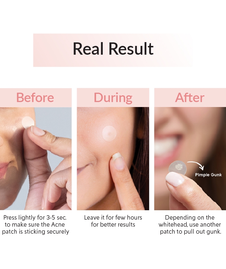 Priveda Spot Clearing Patch 57 patches before, during and after use on pimple