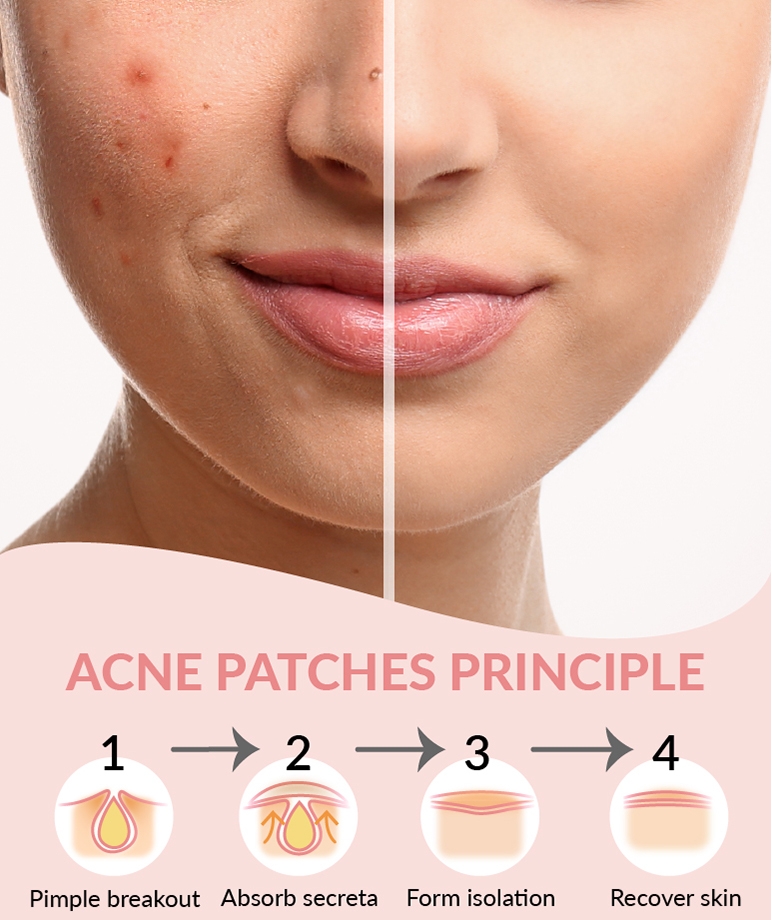 Priveda Spot Clearing Patch 57 patches acne patch principle in 4 steps