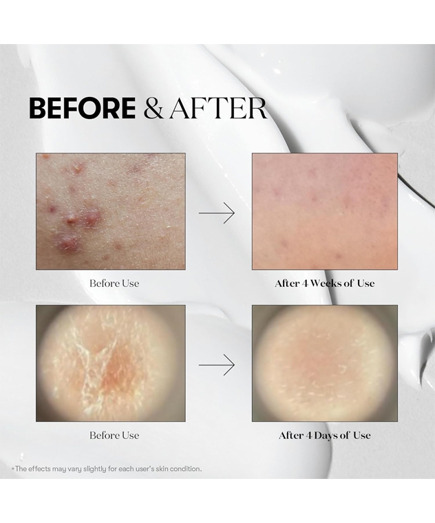 VT Reedle Shot 100 before and after skin texture, 4 days and 4 weeks of use