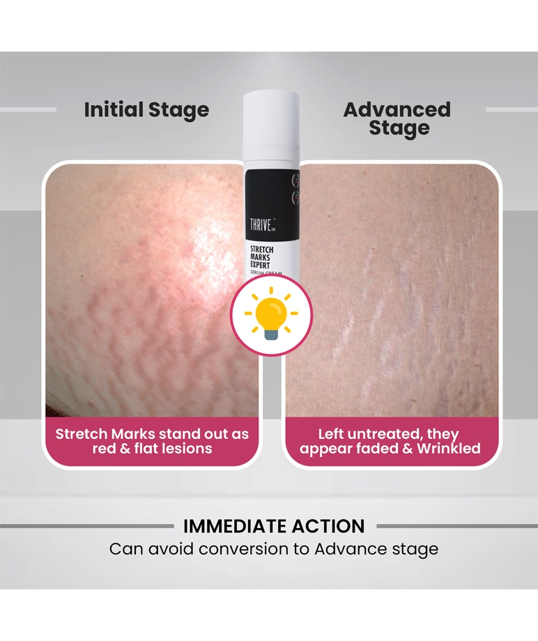 ThriveCo Stretch Marks Expert Serum Cream, 30ml – image 3 of 6