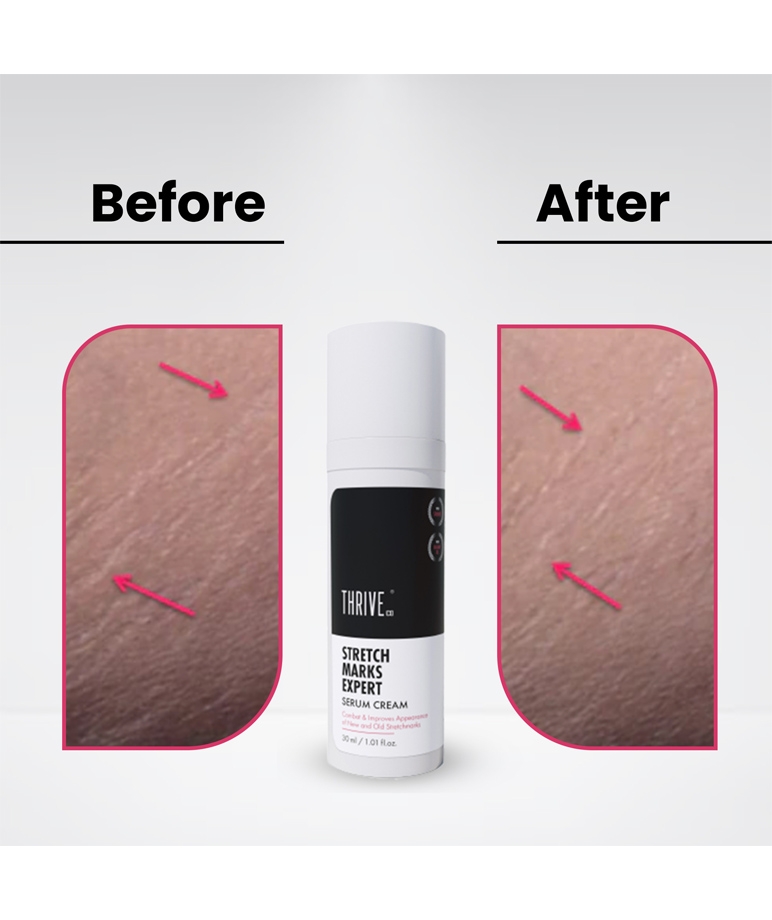 ThriveCo Stretch Marks Expert Serum Cream, 30ml – image 6 of 6