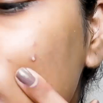 Priveda Spot Clearing Acne Pimple Patch for whitehead pimple on cheek