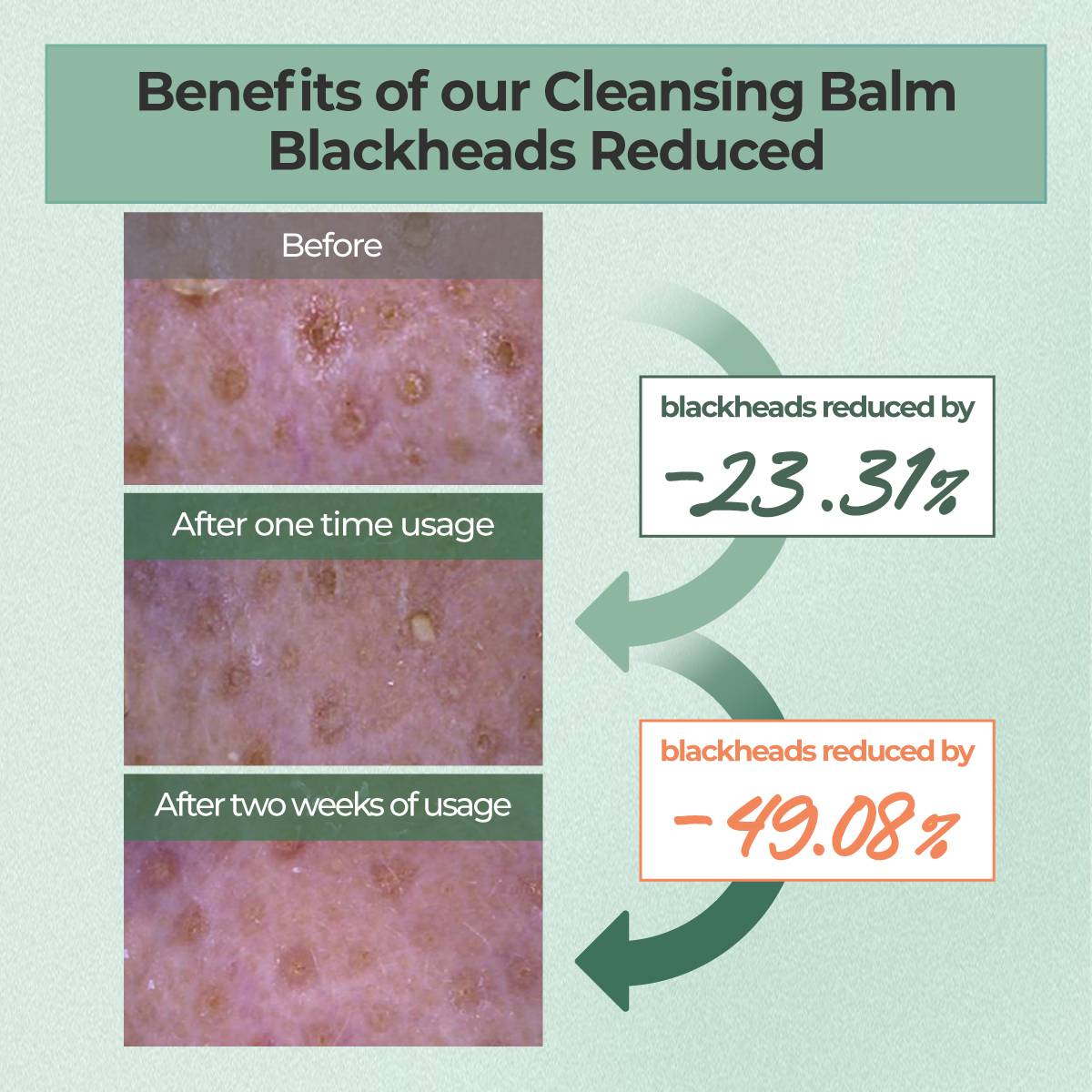 numbuzin No.3 Cleansing Balm 85g blackheads reduced before and after test results